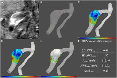 Three-dimensional aneurysm wall enhancement in fusiform intracranial aneurysms is associated with aneurysmal symptoms